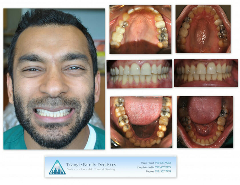 Invisalign-Fareed-1140x880