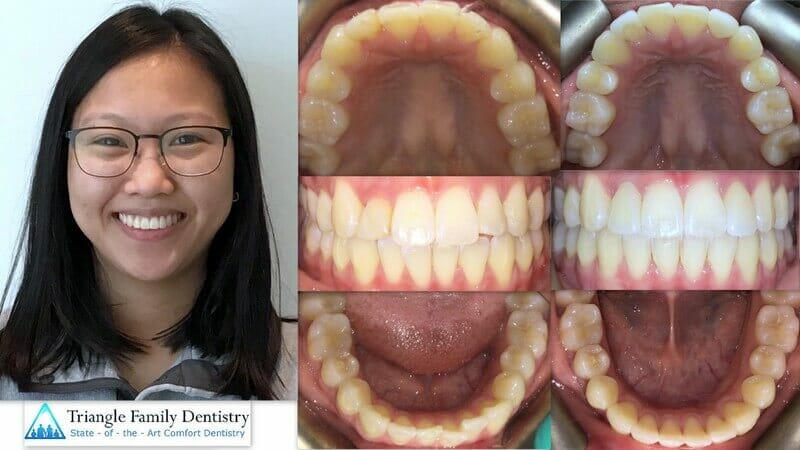 adult-braces-invisalign-cosmetic-dentistry-triangle-family-dentistry-Feb2021