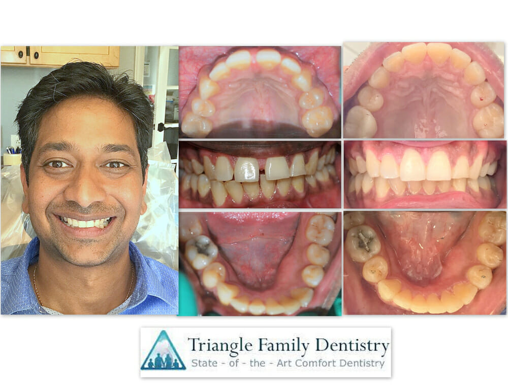 cosmetic-dentistry-morrisville-nc-wake-forest-dental-office-smile-gallery-Jun2017