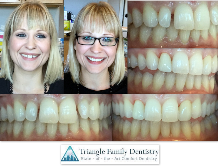 dental-veneers-morrisville-nc-dental-office-1