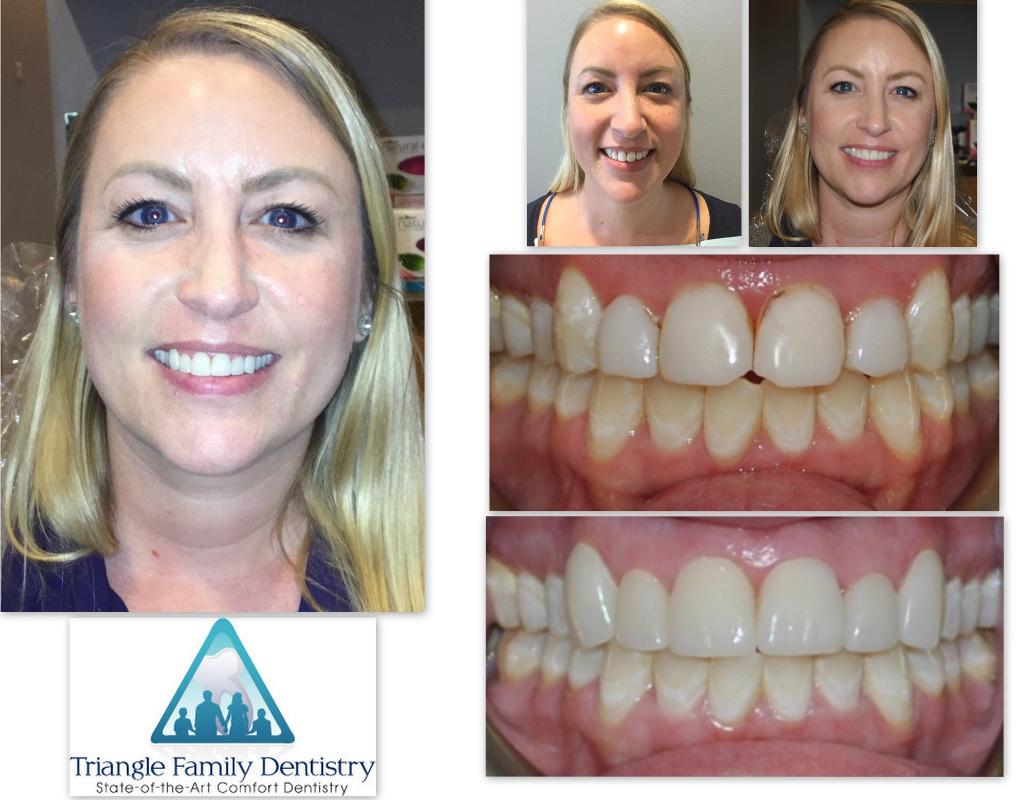 dentist-office-veneers-cosmetic-dentistry-wake-forest-north-carolina