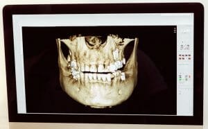 Digital Dental X-Rays