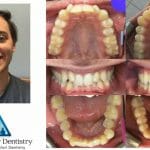 Dental Implants Results