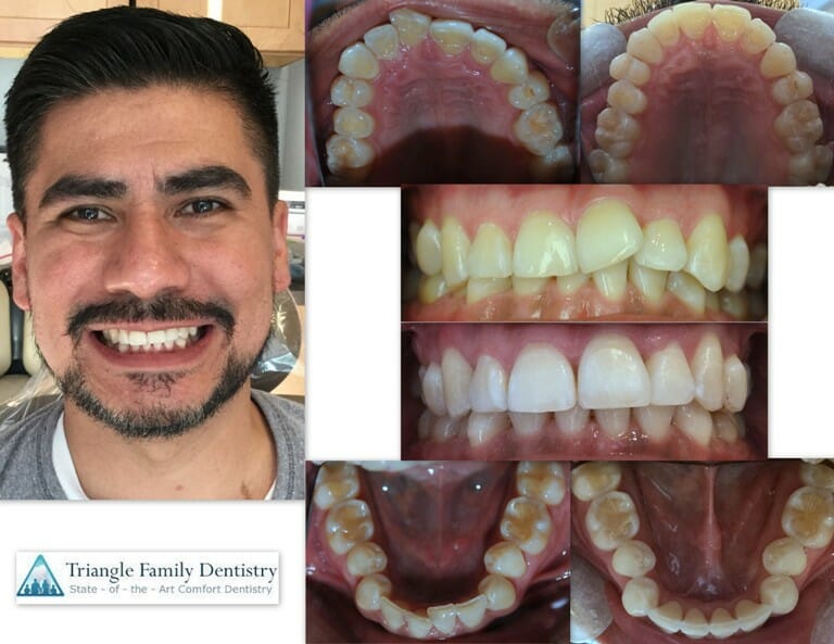 Invisalign Outcomes at TFD - Before and After - Patient Review