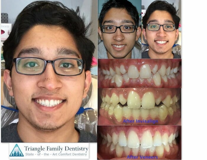 Invisalign Outcomes at TFD - Before and After - Patient Review
