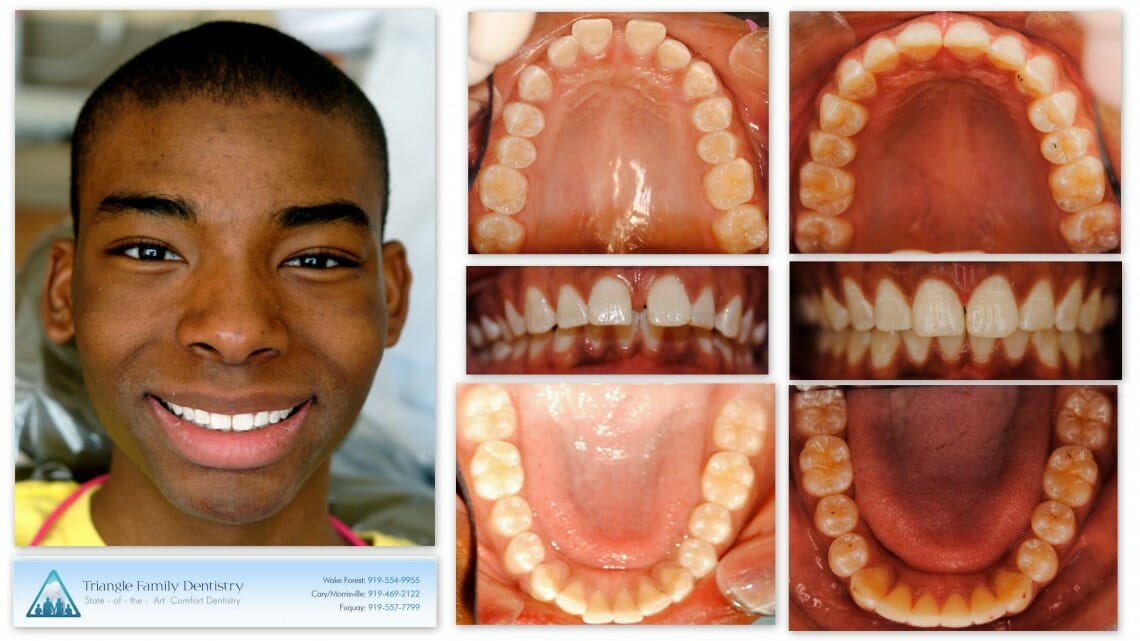Invisalign Outcomes at TFD - Before and After - Patient Review