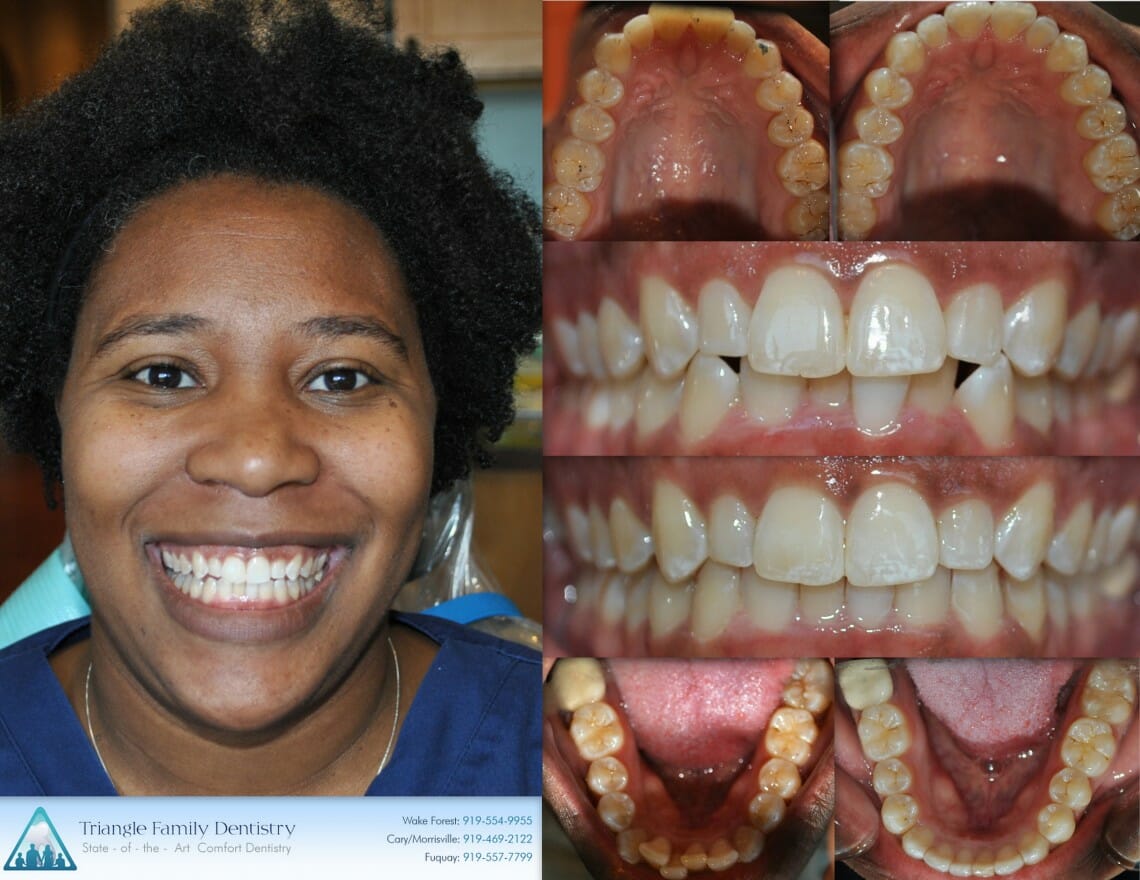 Invisalign Outcomes at TFD - Before and After - Patient Review