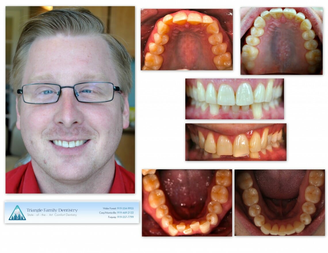 Invisalign Outcomes at TFD - Before and After - Patient Review