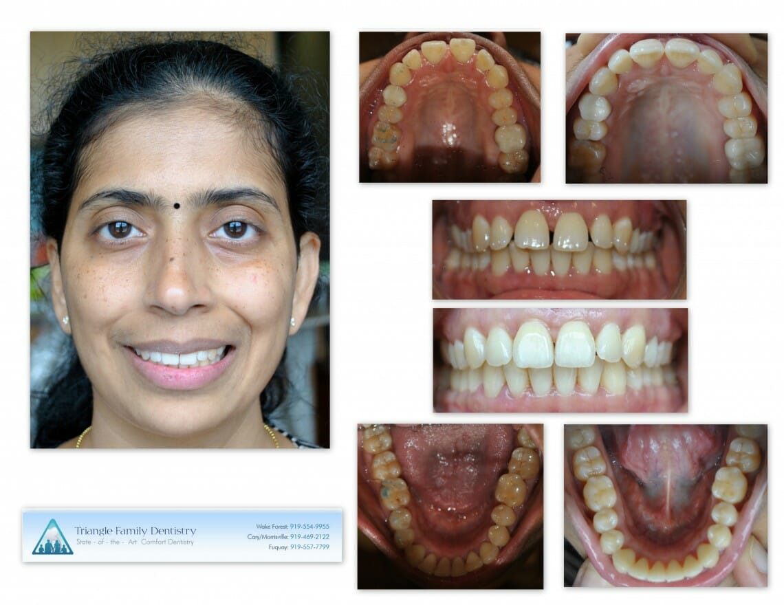 Invisalign Outcomes at TFD - Before and After - Patient Review
