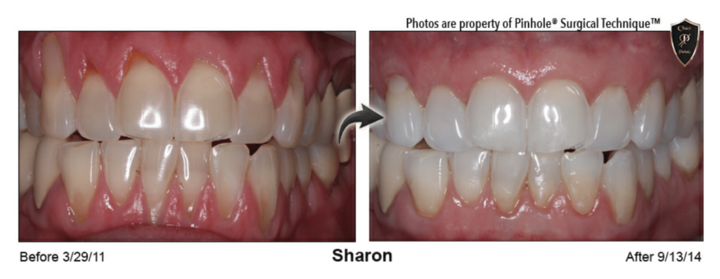 PST Before and After