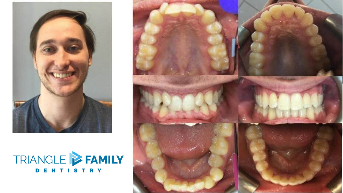 Smile Gallery - Before and After Dental Treatment at Triangle Family Dentistry