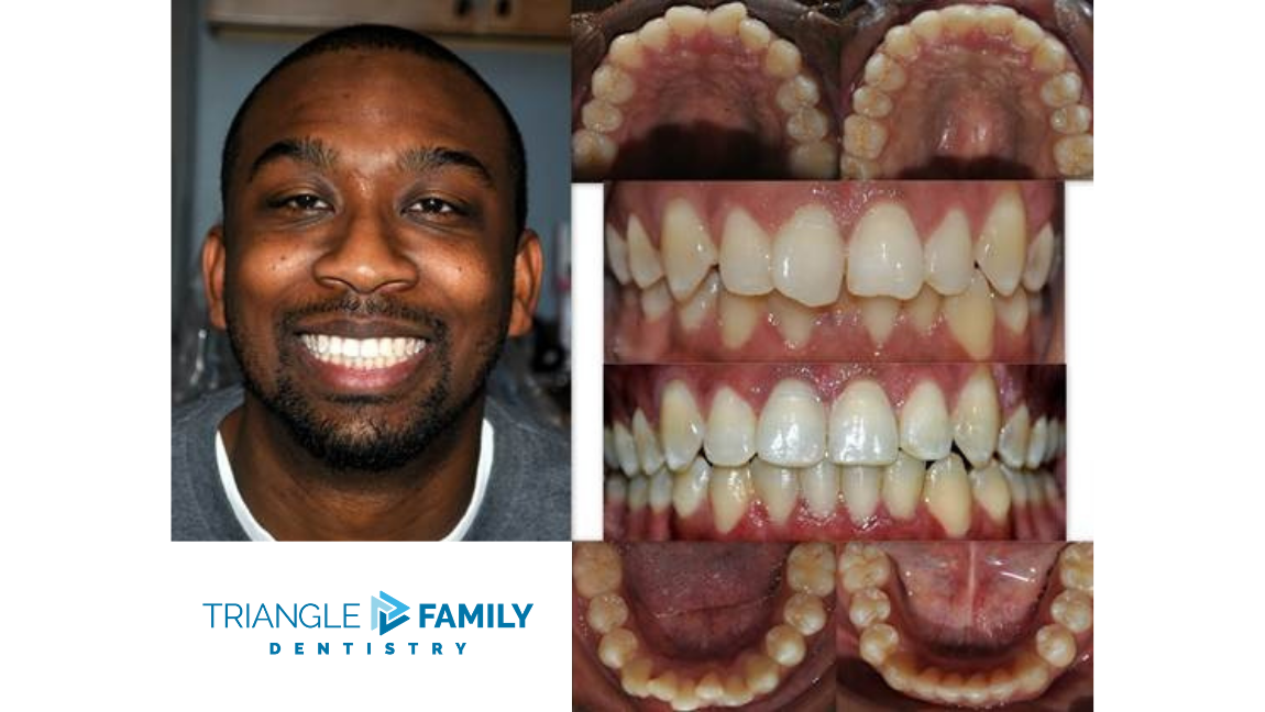 Smile Gallery - Before and After Dental Treatment at Triangle Family Dentistry