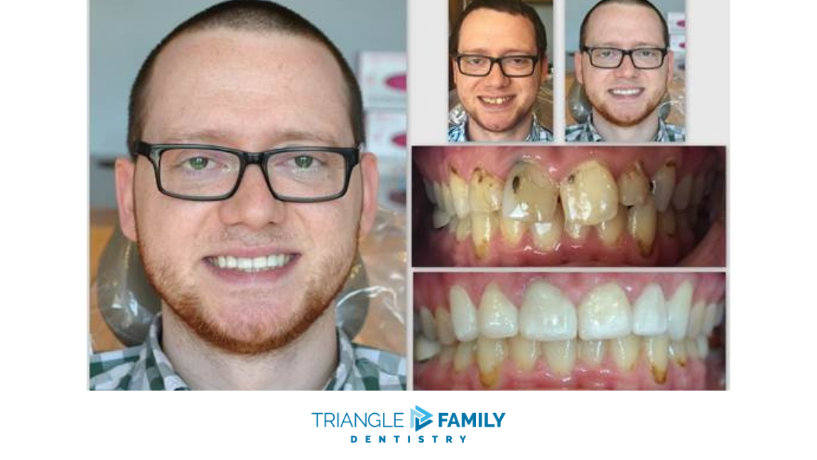 Smile Gallery - Before and After Dental Treatment at Triangle Family Dentistry
