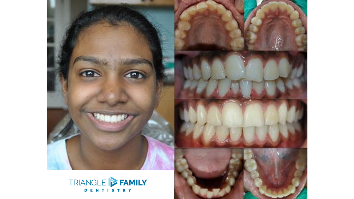 Smile Gallery - Before and After Dental Treatment at Triangle Family Dentistry