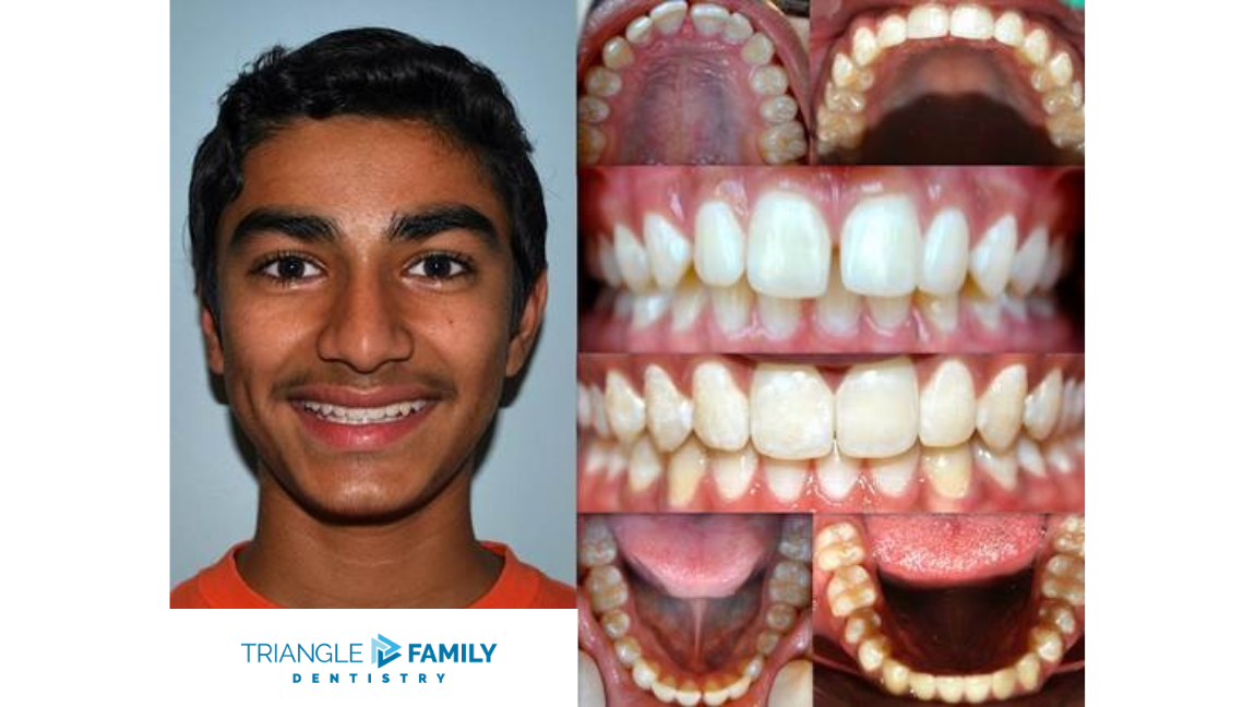 Smile Gallery - Before and After Dental Treatment at Triangle Family Dentistry