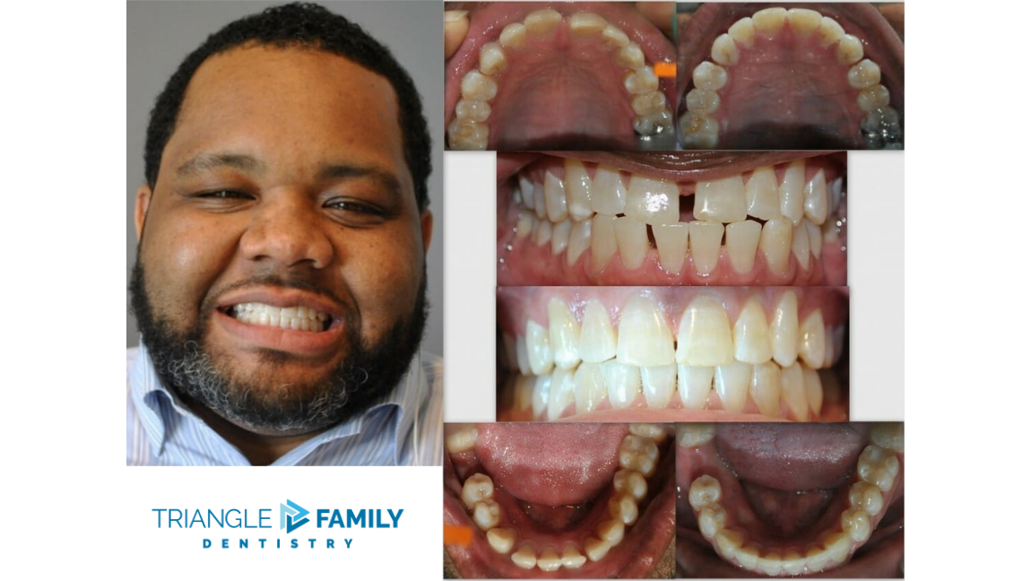 Smile Gallery - Before and After Dental Treatment at Triangle Family Dentistry