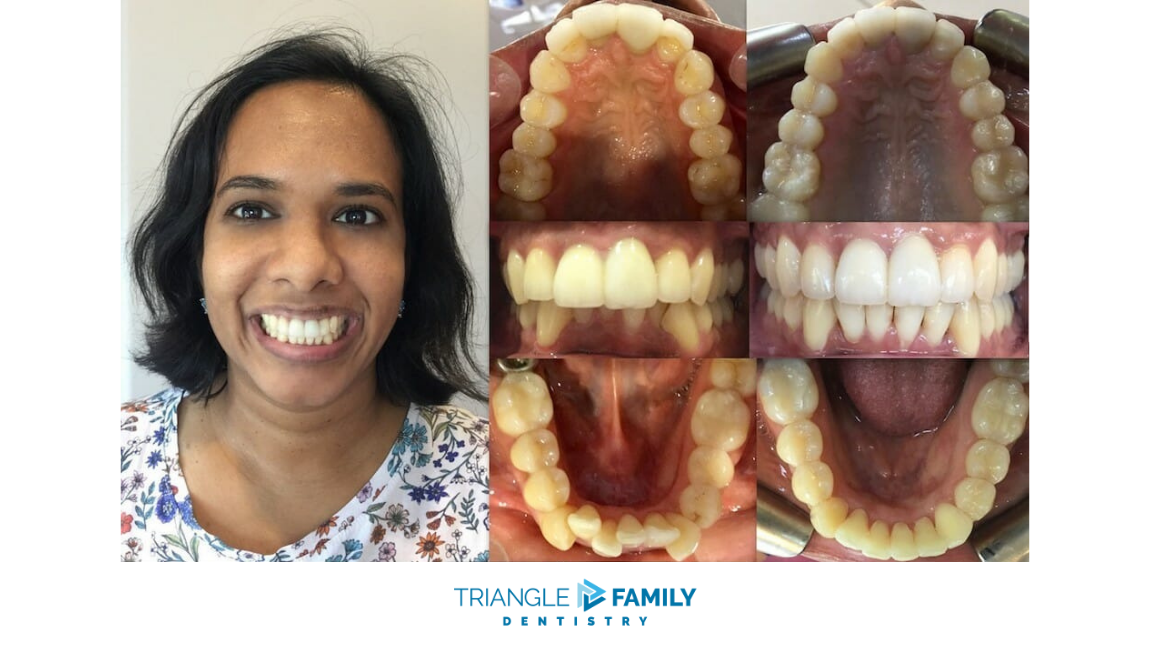 Smile Gallery - Before and After Dental Treatment at Triangle Family Dentistry