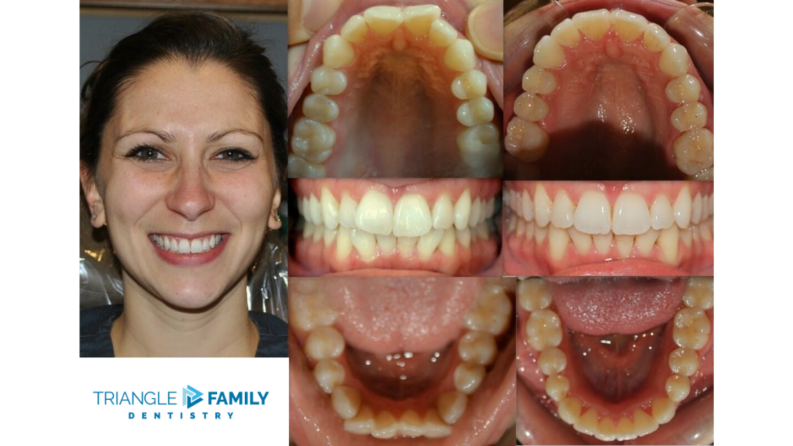 Smile Gallery - Before and After Dental Treatment at Triangle Family Dentistry
