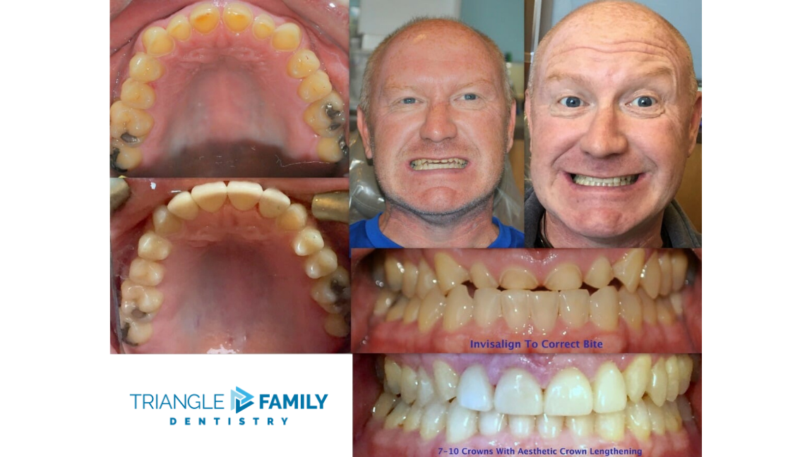 Smile Gallery - Before and After Dental Treatment at Triangle Family Dentistry