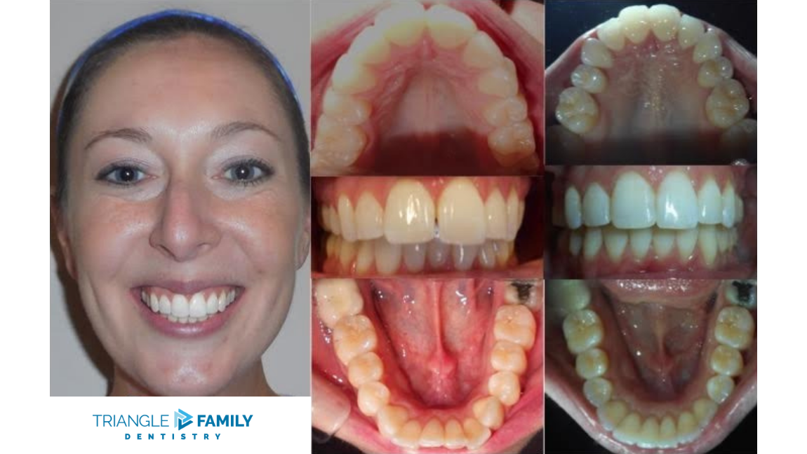 Smile Gallery - Before and After Dental Treatment at Triangle Family Dentistry