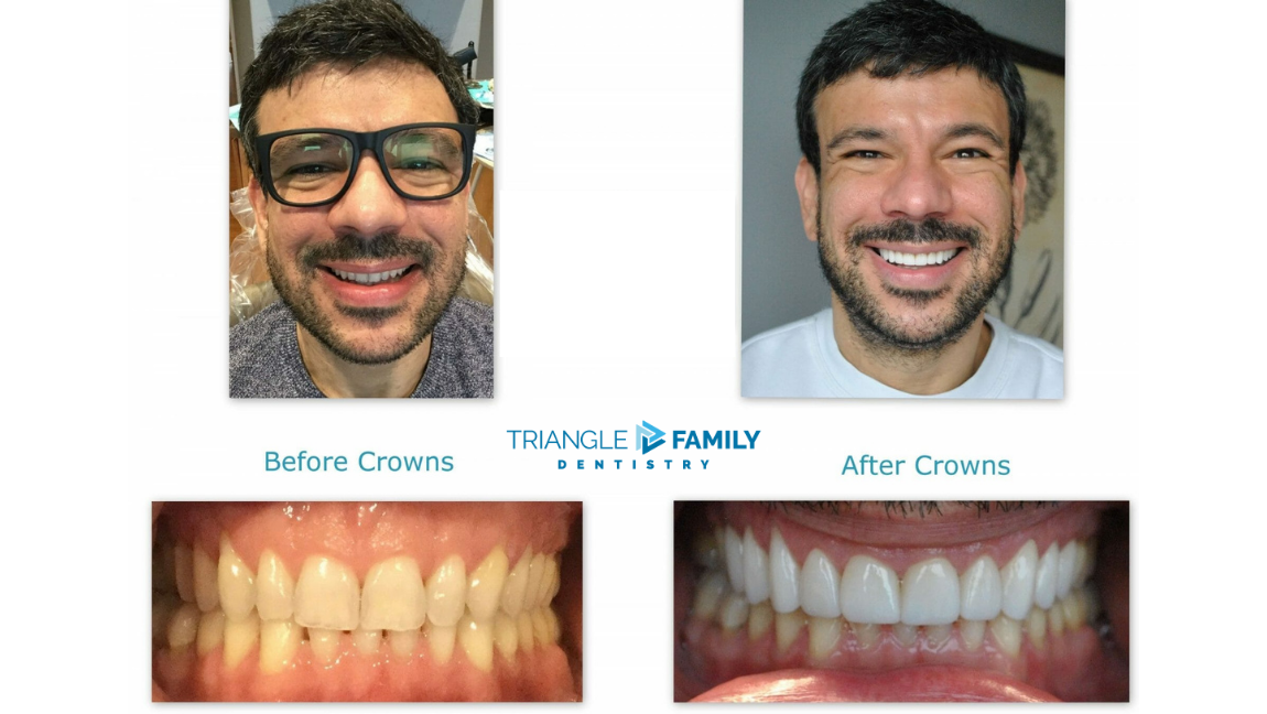 Smile Gallery - Before and After Dental Crowns at Triangle Family Dentistry