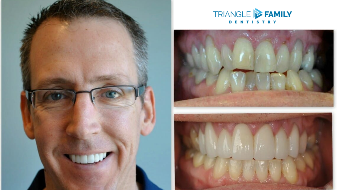 Smile Gallery - Before and After Dental Treatment at Triangle Family Dentistry