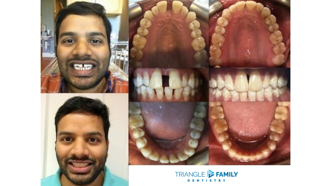 Smile Gallery - Before and After Dental Treatment at Triangle Family Dentistry