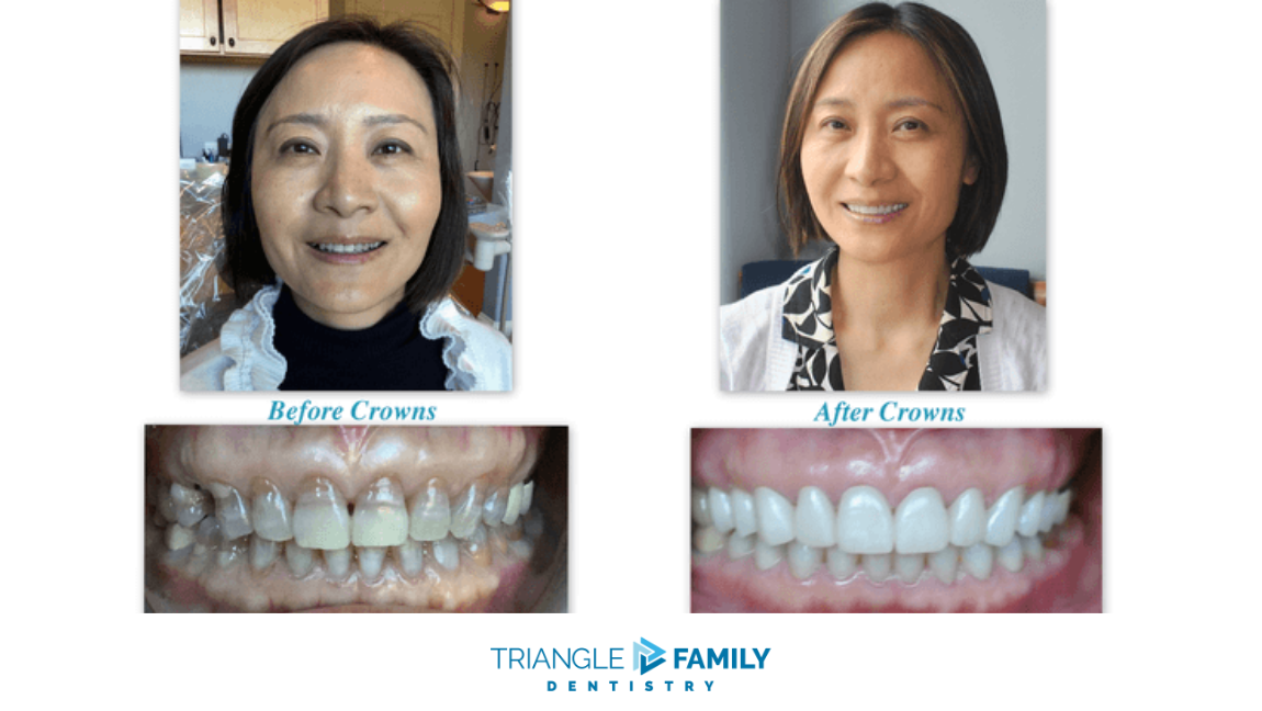Smile Gallery - Before and After Dental Crown at Triangle Family Dentistry