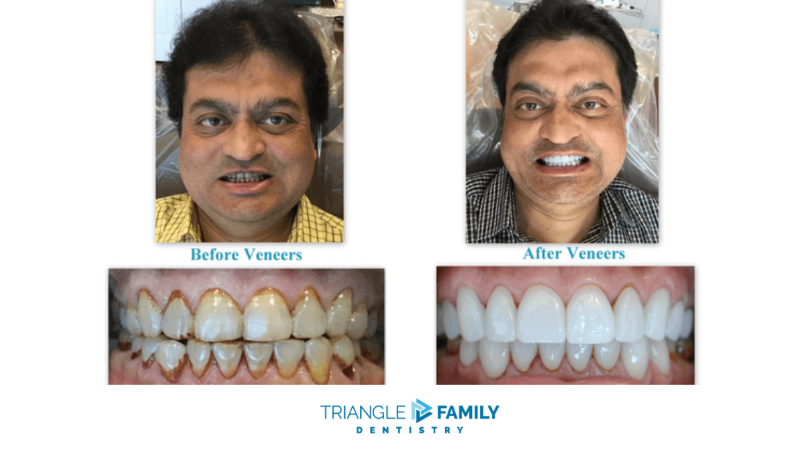 Smile Gallery - Before and After Dental Veneers at Triangle Family Dentistry