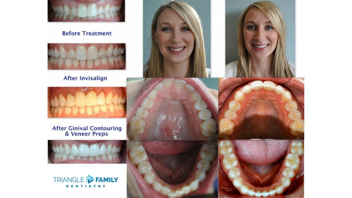 Smile Gallery - Before and After Invisalign at Triangle Family Dentistry