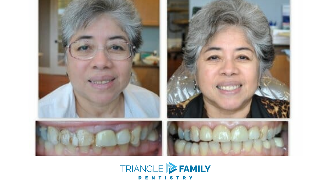 Smile Gallery - Before and After Treatment at Triangle Family Dentistry
