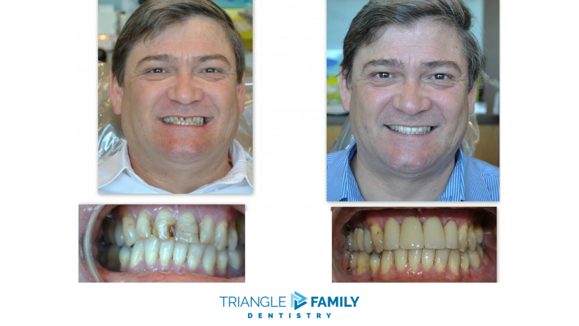 Smile Gallery - Before and After Treatment at Triangle Family Dentistry