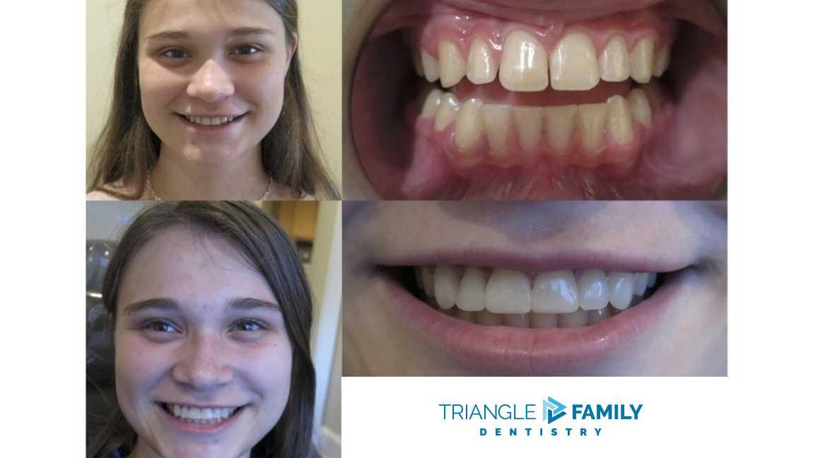 Smile Gallery - Before and After Treatment at Triangle Family Dentistry