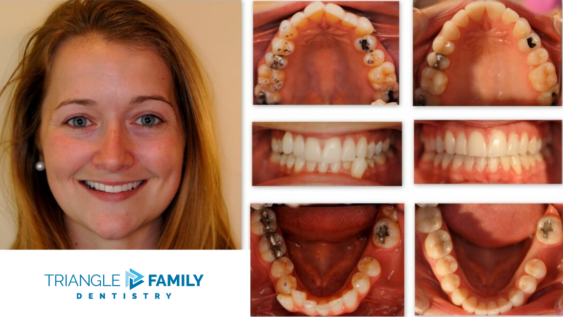 Smile Gallery - Before and After Treatment at Triangle Family Dentistry
