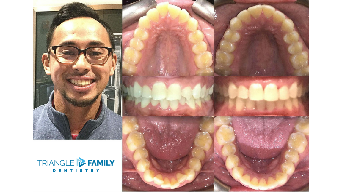 Smile Gallery - Before and After Dental Treatment at Triangle Family Dentistry