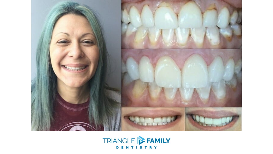 Smile Gallery - Before and After Treatment at Triangle Family Dentistry