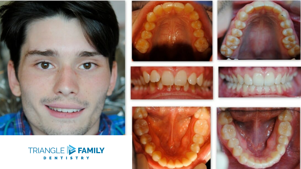 Smile Gallery - Before and After Treatment at Triangle Family Dentistry