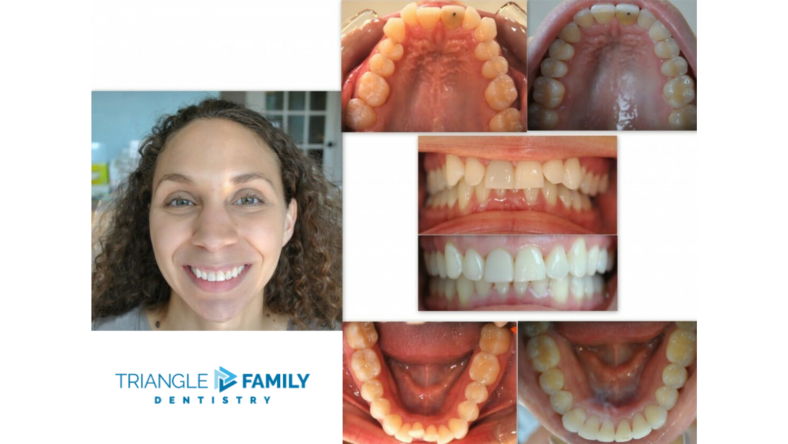 Smile Gallery - Before and After Treatment at Triangle Family Dentistry