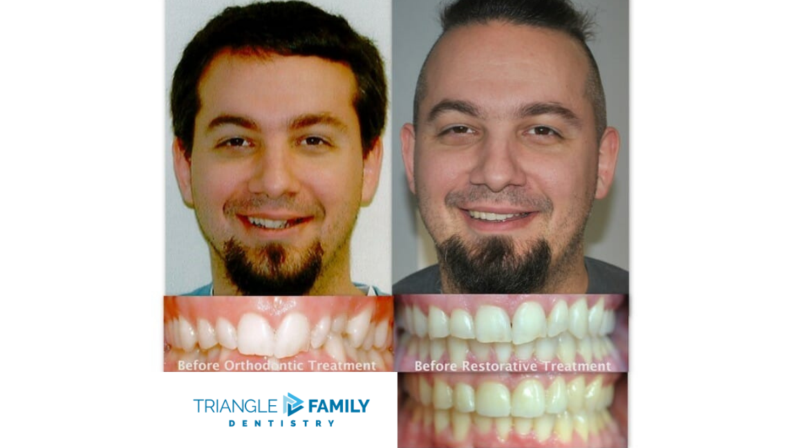 Smile Gallery - Before and After Orthodontic Treatment at Triangle Family Dentistry