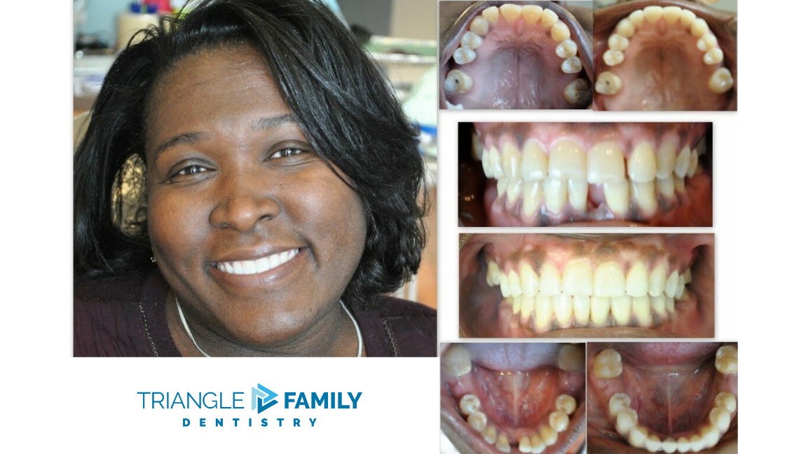 Smile Gallery - Before and After Dental Treatment at Triangle Family Dentistry