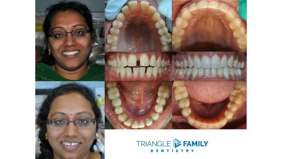Smile Gallery - Before and After Dental Treatment at Triangle Family Dentistry