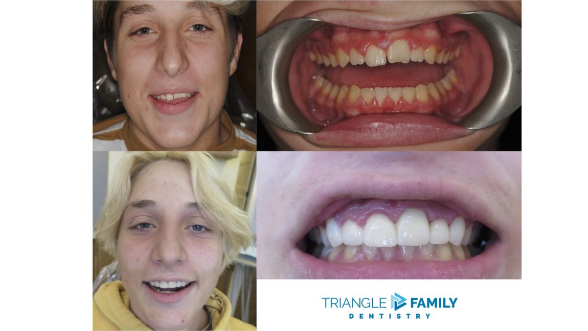 Smile Gallery - Before and After Dental Treatment at Triangle Family Dentistry