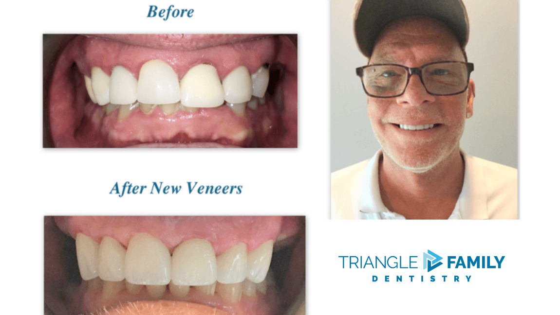 Smile Gallery - Before and After Veneers at Triangle Family Dentistry