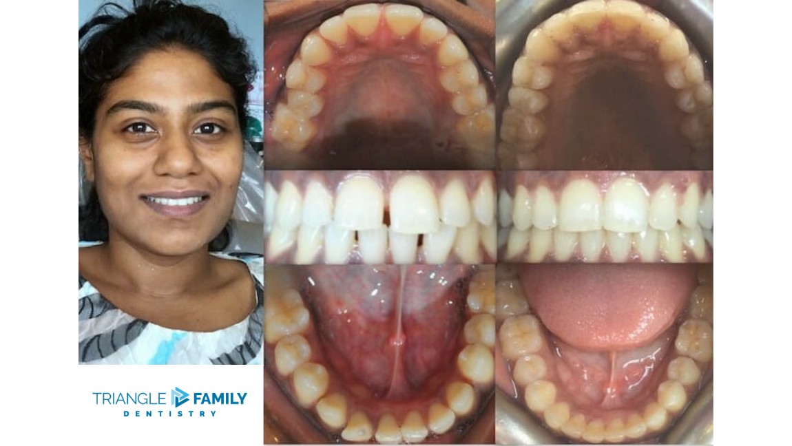 Smile Gallery - Before and After Dental Treatments at Triangle Family Dentistry