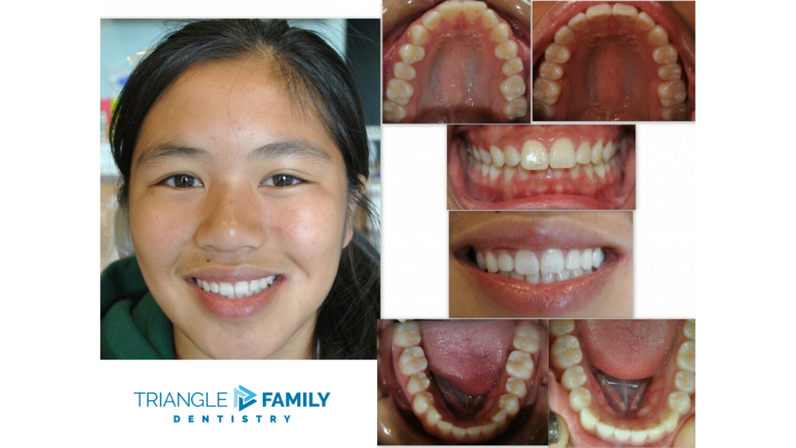 Smile Gallery - Before and After Dental Treatments at Triangle Family Dentistry