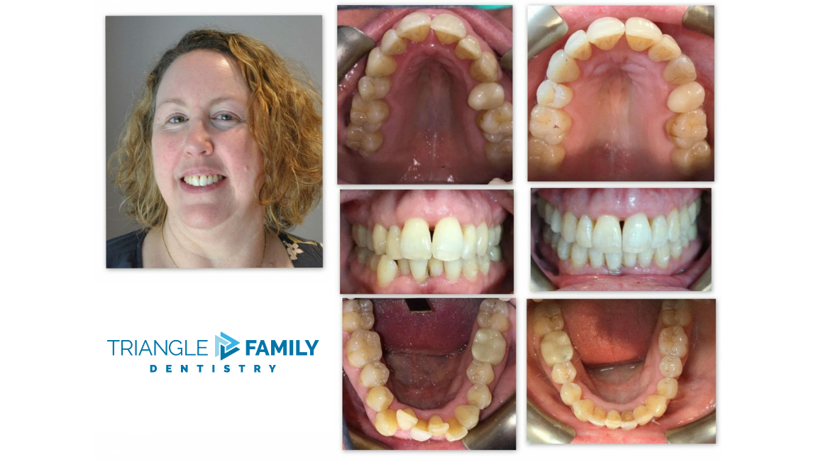 Smile Gallery - Before and After Dental Treatment at Triangle Family Dentistry