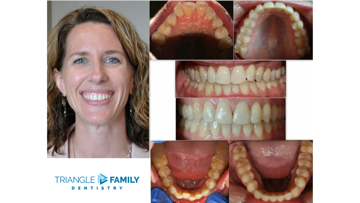 Smile Gallery - Before and After Dental Treatments at Triangle Family Dentistry