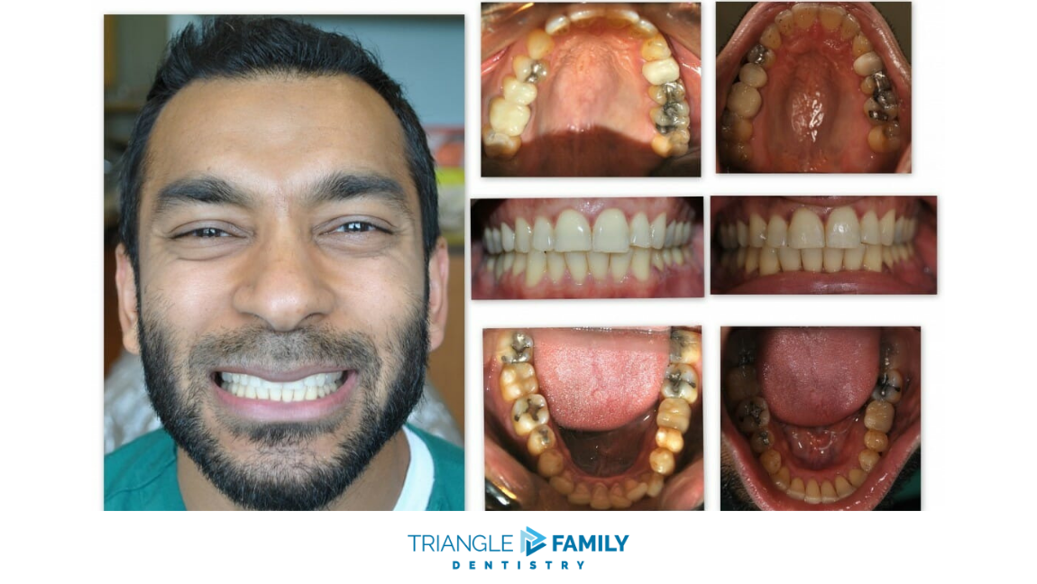 Smile Gallery - Before and After Dental Treatments at Triangle Family Dentistry