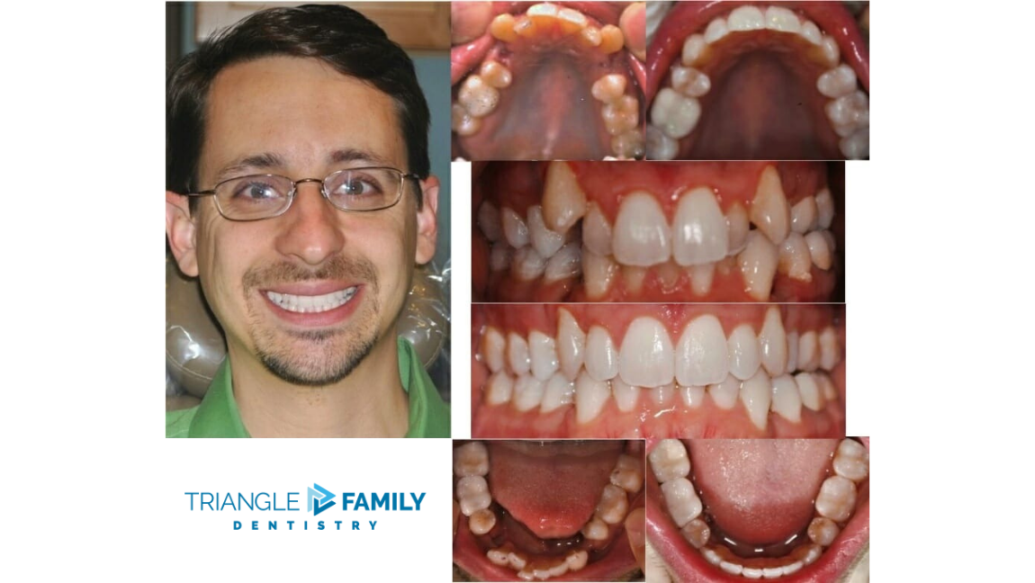 Smile Gallery - Before and After Dental Treatments at Triangle Family Dentistry