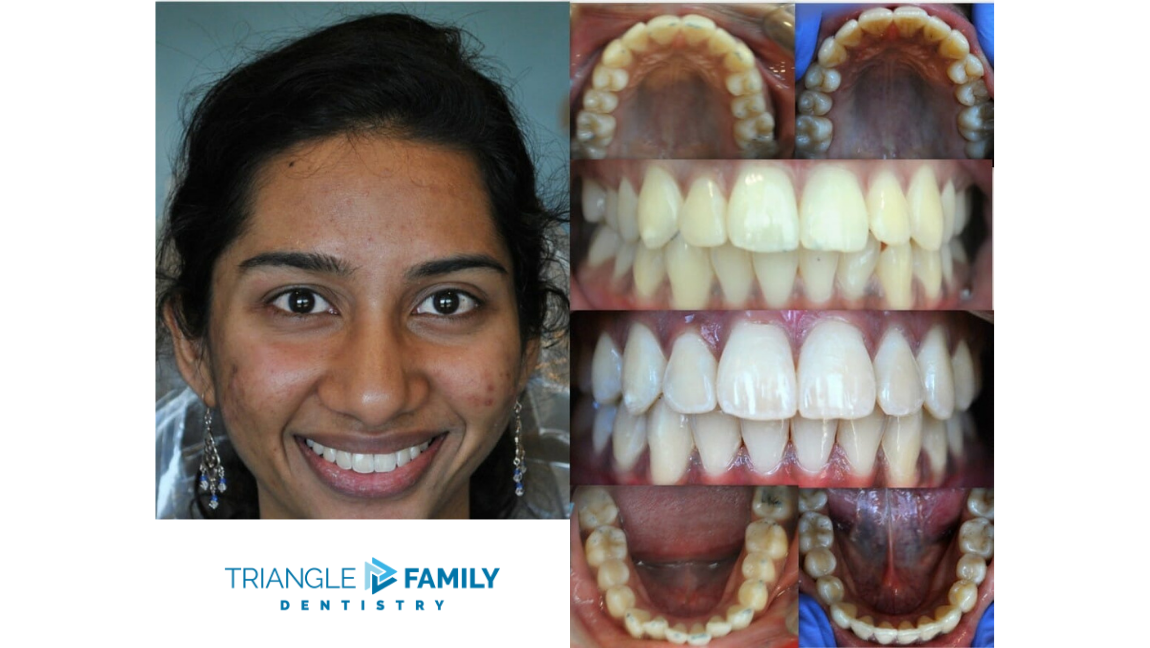 Smile Gallery - Before and After Dental Treatments at Triangle Family Dentistry